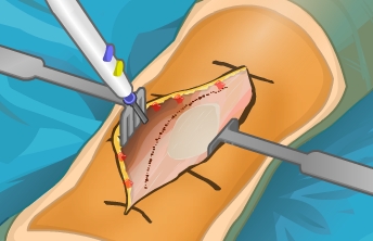 Virtual Knee Surgery - screenshot 2 Virtual Knee Surgery
